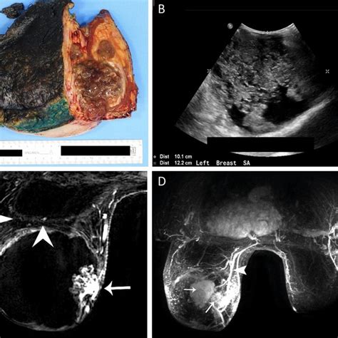 Phyllodes Tumors May Display A Range Of Ultrasound Appearances And