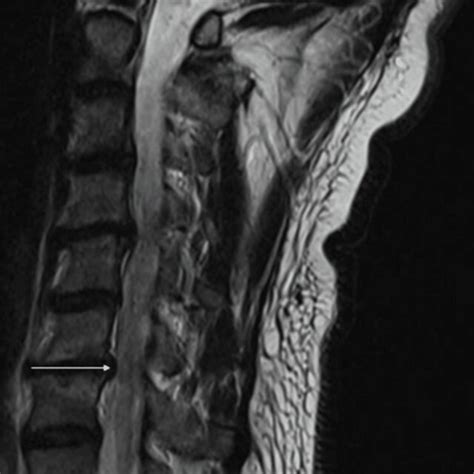 Preoperative T Weighted Mri Of The Cervical Spine Axial View