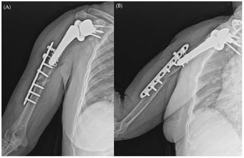 Wrist Pain After Humerus Fracture at Gustavo Gomez blog
