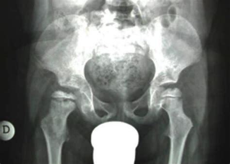 Perthes Disease - Prof. Nicola Portinaro - Orthopedic Suregon