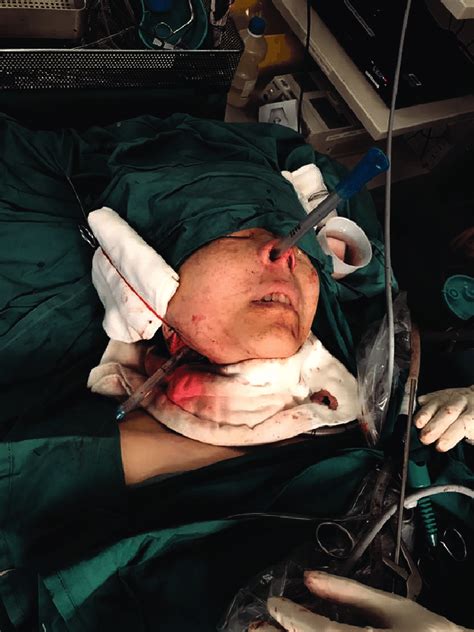 Chest Tube Pulled From Nasopharynx Into Neck Via Previously Created