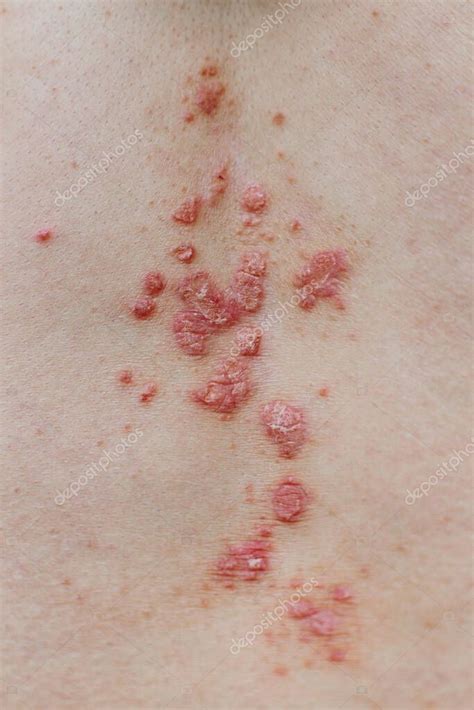 Psoriasis Vulgar Piel La Psoriasis Es Una Enfermedad Autoinmune Que Afecta A La Piel Y Causa