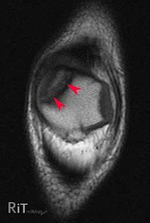 RiT radiology: Painful Bipartite Patella