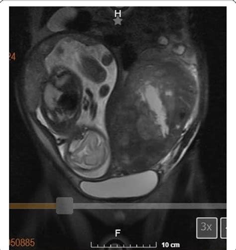 Abdominal Pelvic Magnetic Resonance Imaging T1 Sequence Pregnancy