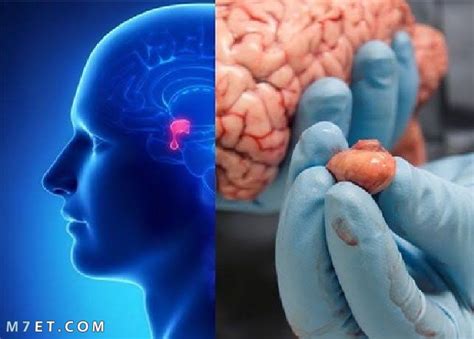 طرق علاج الغدة النخامية بالأعشاب والطرق الطبيعية