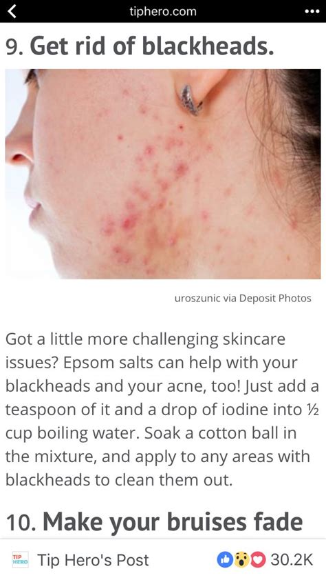 Epsom Salt Acne Get Rid Of Blackheads Face Scrub Face Moisturizer