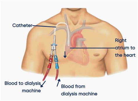 kidney port surgery understanding dialysis access surgery azura