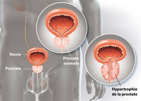 Adénome de la prostate L examen urologique