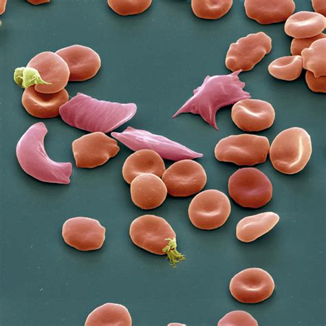 Sickle Cell Anemia Under Microscope