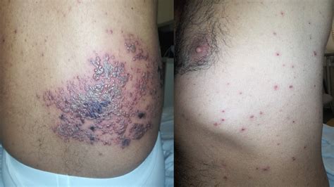 A HIV-positive subject with dermatomal and generalized vesicular skin
