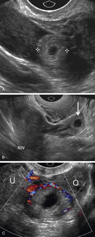 Abdominal Ectopic Pregnancy Ultrasound Ectopic Pregnancy