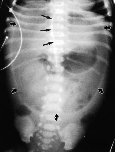 Image Neonatal Football Sign