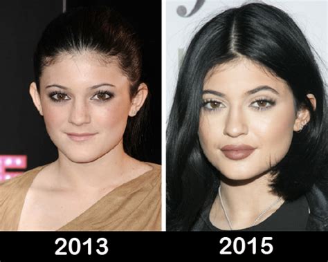 Kylie Jenner Before and After Plastic Surgery Photos | Celebrity ...