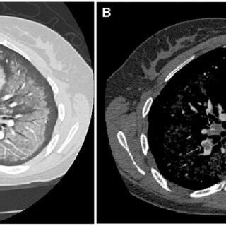 (PDF) Crack Lung: Cocaine induced lung injury