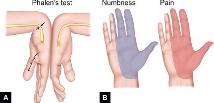 reverse phalens test