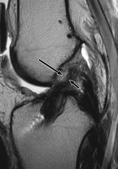 Mr Imaging Of Complications Of Anterior Cruciate Ligament Graft