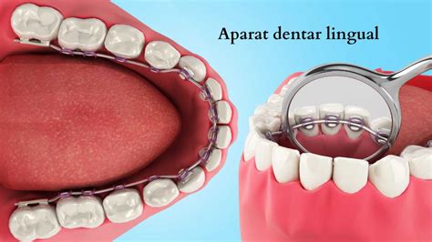 Aparat Dentar Lingual Avantaje Si Metode De Intretinere