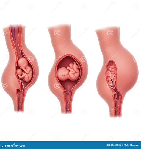 Abdominal Aortic Aneurysm Cartoon Vector | CartoonDealer.com #383868887