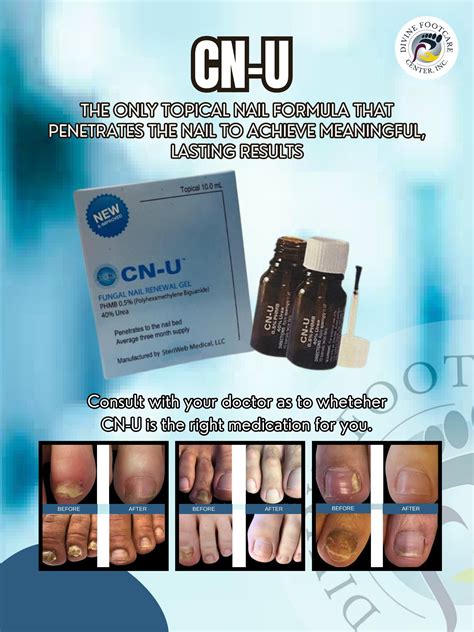 Fungal Toenail Treatment Santa Monica | Onychomycosis Podiatrist