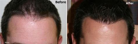 2500 Graft Hairline Restoration Alvi Armani Hair Transplant Los Angeles