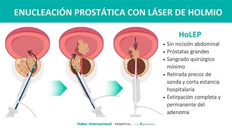 Cirurgia De Próstata A Laser - Hiperplasia benigna de próstata: tratamiento mediante enucleación con ...