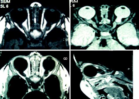 staphyloma mri
