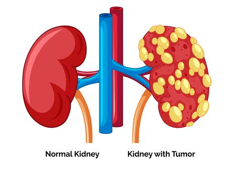 Kidney Cancer-Personalized Oncological Solutions-