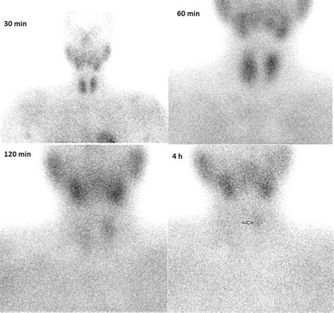 Technetium Sestamibi Scintigraphy Image Technetium Sestamibi