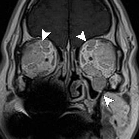 igg related disease   head  neck ct   imaging