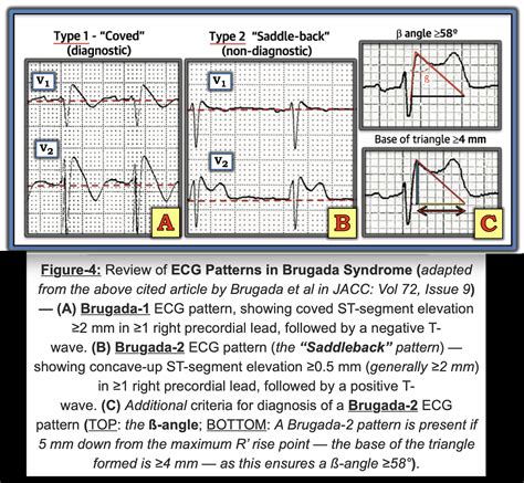 Left Ventricular Hypertrophy Ecg 12