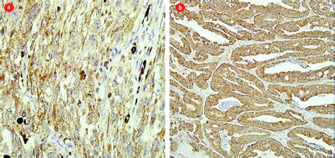 Positive control for the anti-BRAF V600E antibody. (a) Melanoma tissue... | Download Scientific ...