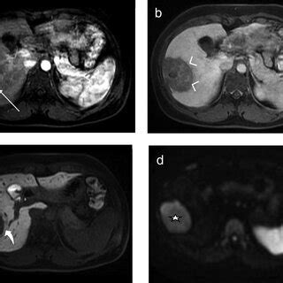 -Enhanced MRI scan with liver-specific contrast agent; (A) arterial ...