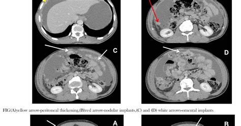 RADIOLOGICAL FINDINGS :PERITONEAL CARCINOMATOSIS - Sumer's Radiology Blog