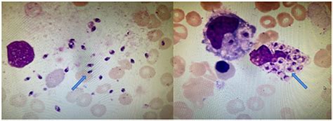 Frontiers Leishmania Donovani Visceral Leishmaniasis Diagnosed By