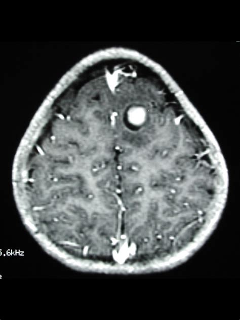 Pediatric Brain Tumor in New Jersey | NJPNI