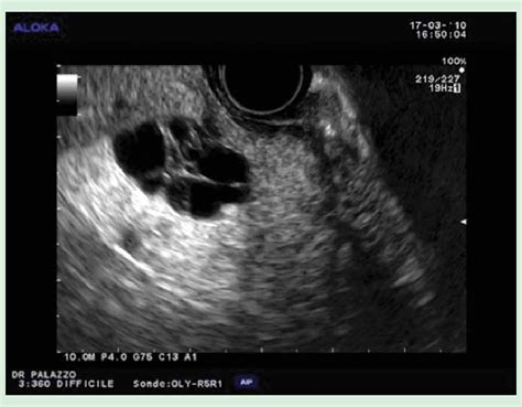 Serous Cystadenoma Ultrasound