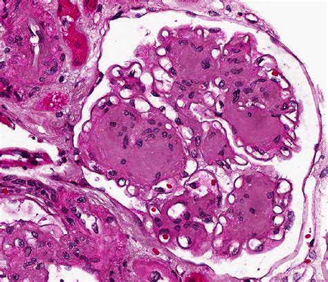 Pathology Outlines Diabetic Kidney Disease