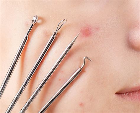 Blackheads 101 Learn How Blackheads Form What Causes Them And How To