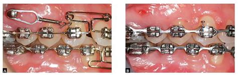 brasil understanding  basis  space closure  orthodontics