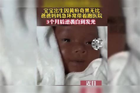 宝宝出生因黄疸奇黑无比，爸爸妈妈急坏常带着跑医院，3个月后逆袭白到发光