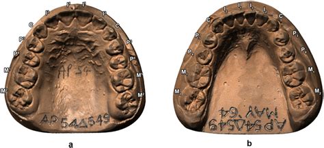 Tooth Wear Development In The Australian Aboriginal Dentition From