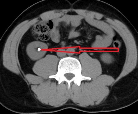 Kidney Stone Cat Scan