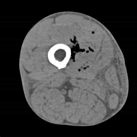 Necrotizing Fasciitis Musculoskeletal Case Studies Ctisus Ct Scanning