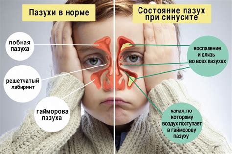 Ринит, гайморит и синусит: отличия и лечение