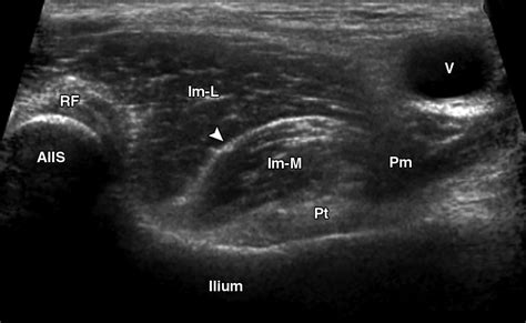 Groin Lymph Nodes Ultrasound