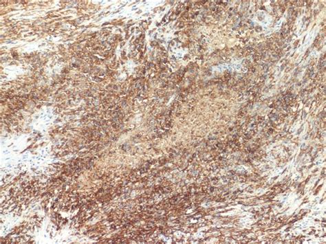 Pathology Outlines Epithelial Membrane Antigen Ema