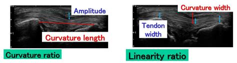 Motion Analysis Of The Extensor Carpi Ulnaris In Triangular