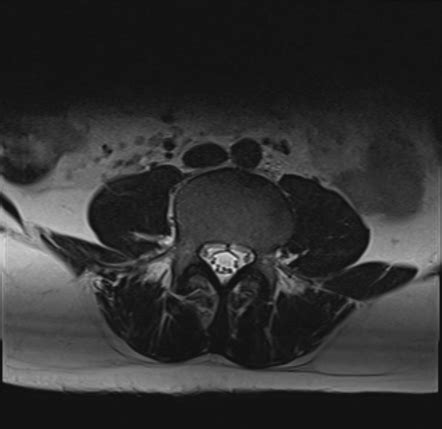 Lumbar Scheuermann Disease Image Radiopaedia Org