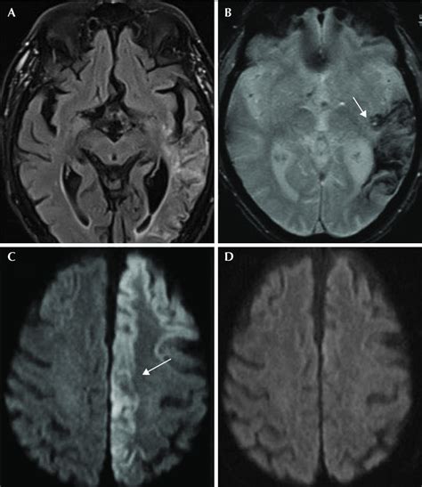 MRI Findings In A 73 Year Old Man With Status Epilepticus Two Years