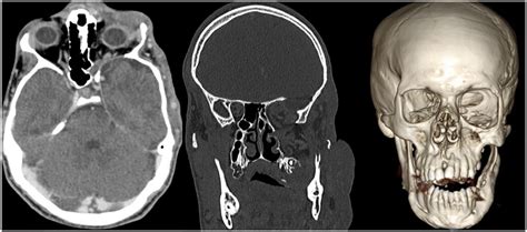 Sphenoid Dysplasia